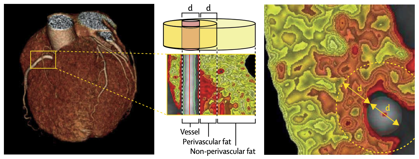 CRISP-CT figure — The Lancet 2018